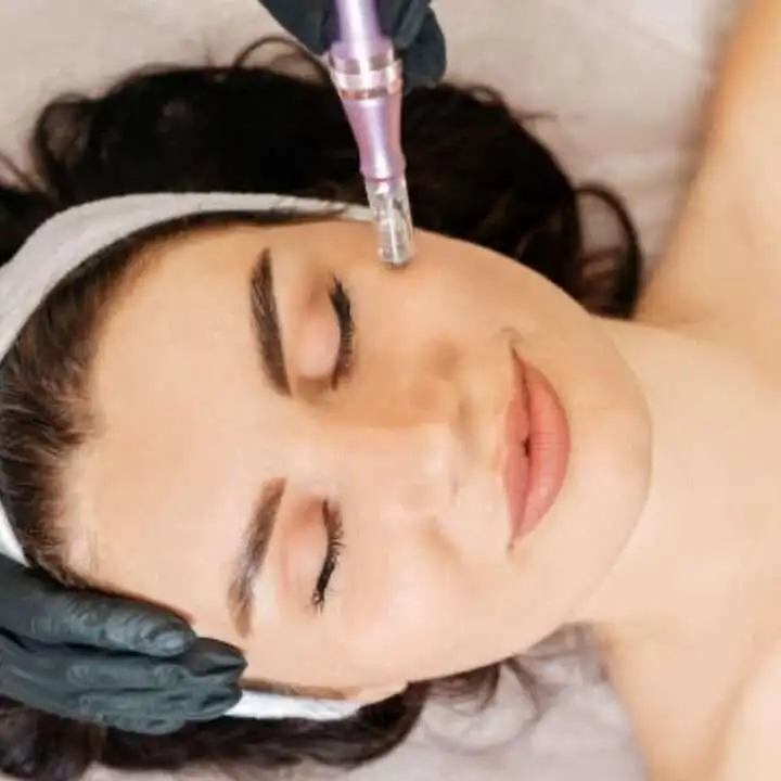 Patient receiving microneedling treatment on forehead with handheld device